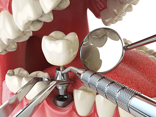 Best Emergency Broken Tooth Repair in Marion, WI